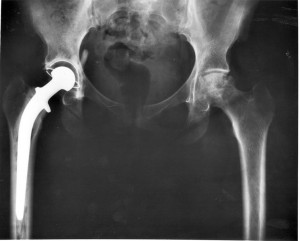 Hip_replacement_Image_LineOne