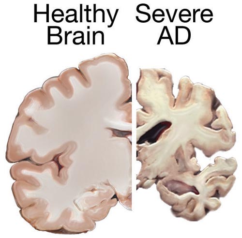 Healthy brain next to a brain with severe Alzheimer's Disease.