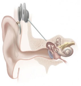 Graphic illustrating cochlear implant, courtesy National Institutes of Health via Wikimedia Commons