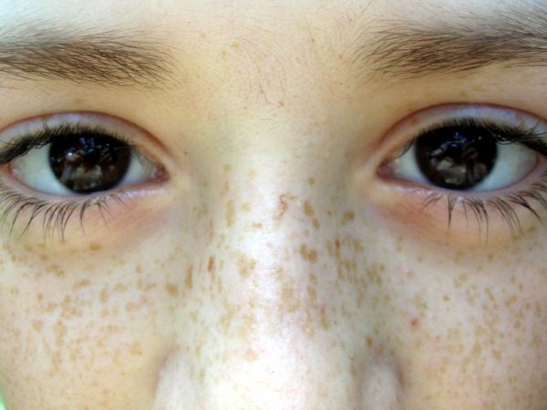 freckles, eyes